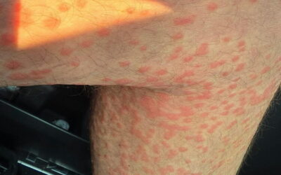 Swimmer’s Itch Article – Minnesota Star Tribune